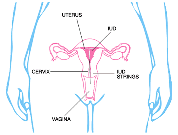 MDstateOfMind's tweet photo. The 411 on IUD's. The most effective form of birth control that you never hear about. #mantra #reproductiveHealth  https://t.co/GMHmZGWVzb https://t.co/UgDLz8uU7o