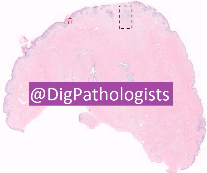 DigPathologists's tweet photo. DigPath Case 22: https://t.co/ltqR5G5IxK  
48 year old woman with an eczematous nipple @pathboards @pathology @BreastPathology https://t.co/pNfst6WgJI