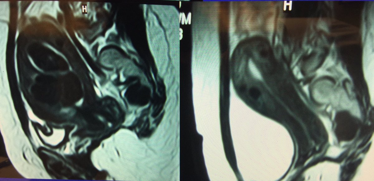 DrRoizental's tweet photo. #irad UFE. MRI before and after. Submucosal and intramural fibroids GONE!  Heavy periods GONE! Outpatient.  Avoid #hysterectomy https://t.co/urP6txanVi