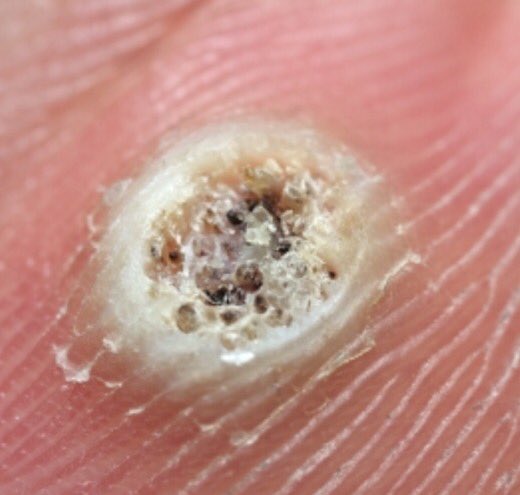 papilloma stages footcare by victoriafeet papilloma stages footcare by victoriafeet