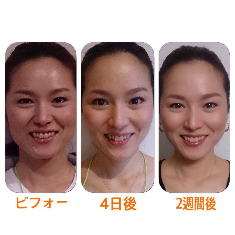 鷹村アオイ 顔ヨガって意外と知られていないのですね 私は新潟市の櫻井亜希子先生から教わりました 整形級と言われる 顔ヨガの成果がこちら T Co Ajj9bcllcp 鷹村アオイ 顔ヨガって意外と知られていないのですね 私は新潟市の櫻井亜希子先生から教わりました 整形級と言われる 顔ヨガの成果がこちら T Co Ajj9bcllcp