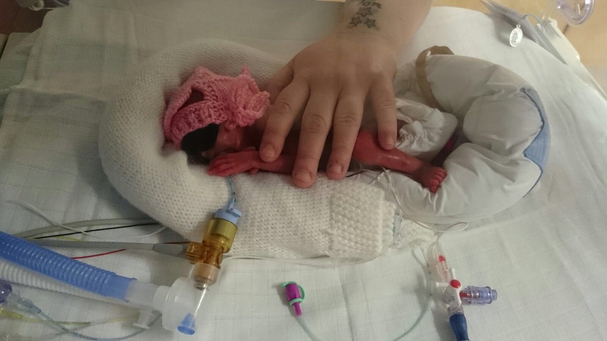 c Breakfast More Premature Babies Than Ever Are Surviving Without Developing Disabilities Earlier We Met Francesca Who Was Born At Just 24 Weeks T Co Bgzhyz7qay