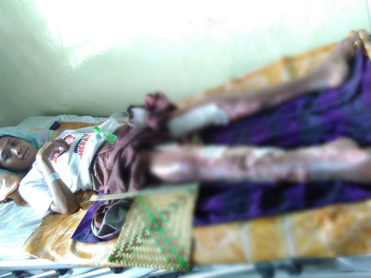 SRbergerak's tweet photo. 3. Dua tahun yang lalu Sholeh mengalami musibah tersengat listrik tegangan tinggi &amp; membakar 90% tubuhnya
#SedekahRombongan https://t.co/tMLRLWaukJ