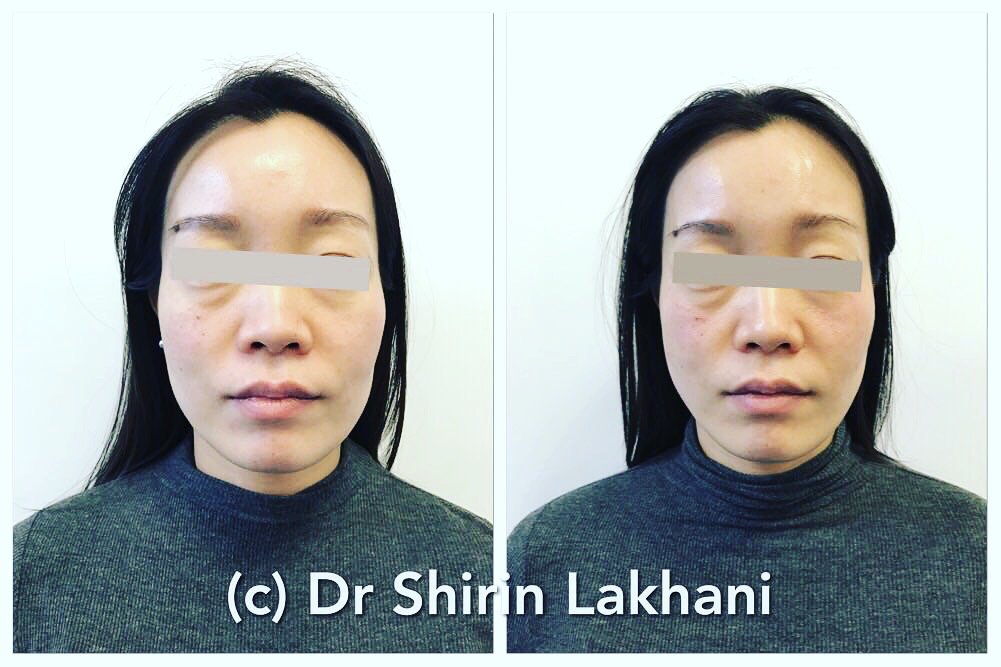 Elite_Aesthetic's tweet photo. Fab results using @Elionce_UK  #threadlifts by @DrShirin_  #slims #lowerface https://t.co/cVtZEbWqld #kent #bexley #greenhithe #dartford https://t.co/xhQZpmPJV8