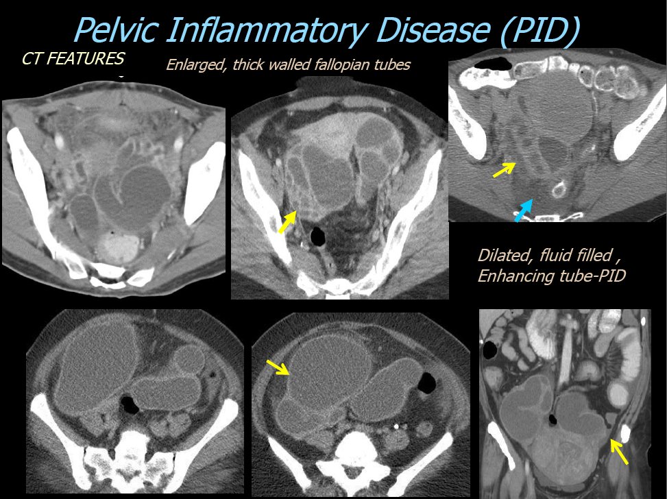 Pelvic Inflammatory Disease Scan