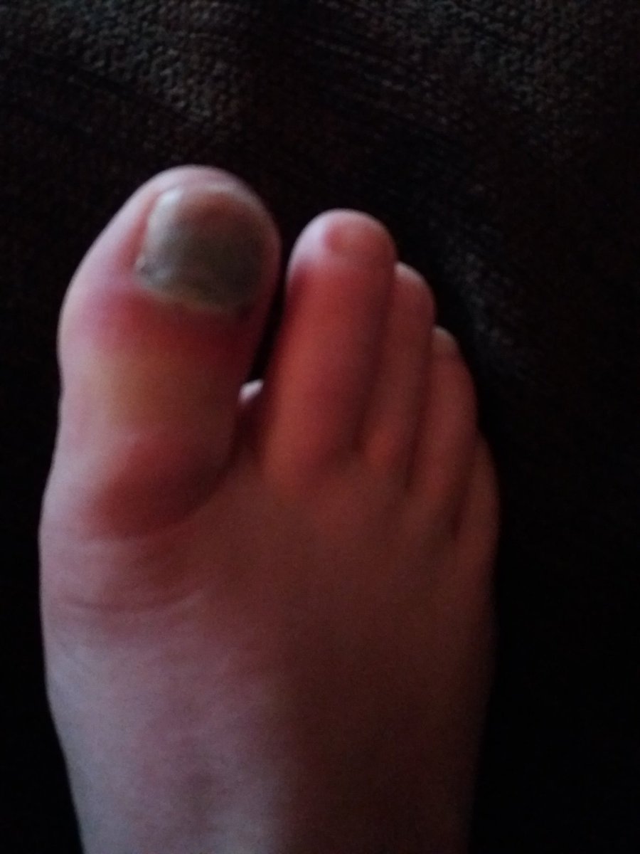 katanne2004's tweet photo. #ouch #painful https://t.co/nZ8skeTjpK