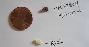 ContentMot's tweet image. What Causes Kidney Stones contentandmotion.com/causes-kidney-…