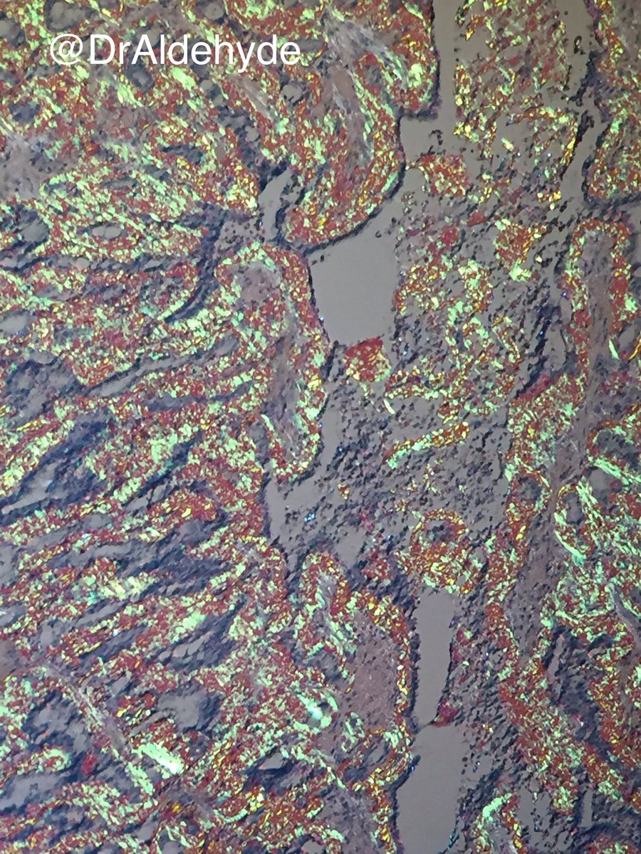 DrAldehyde's tweet photo. Seriously, what's prettier than seminal vesicles with amyloidosis? #pathology#GUpath#pathart @SueEPig @CLValley1 @BerkaLurk https://t.co/7jj7aPLgc5