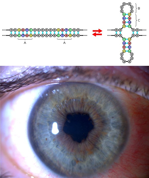 synechia