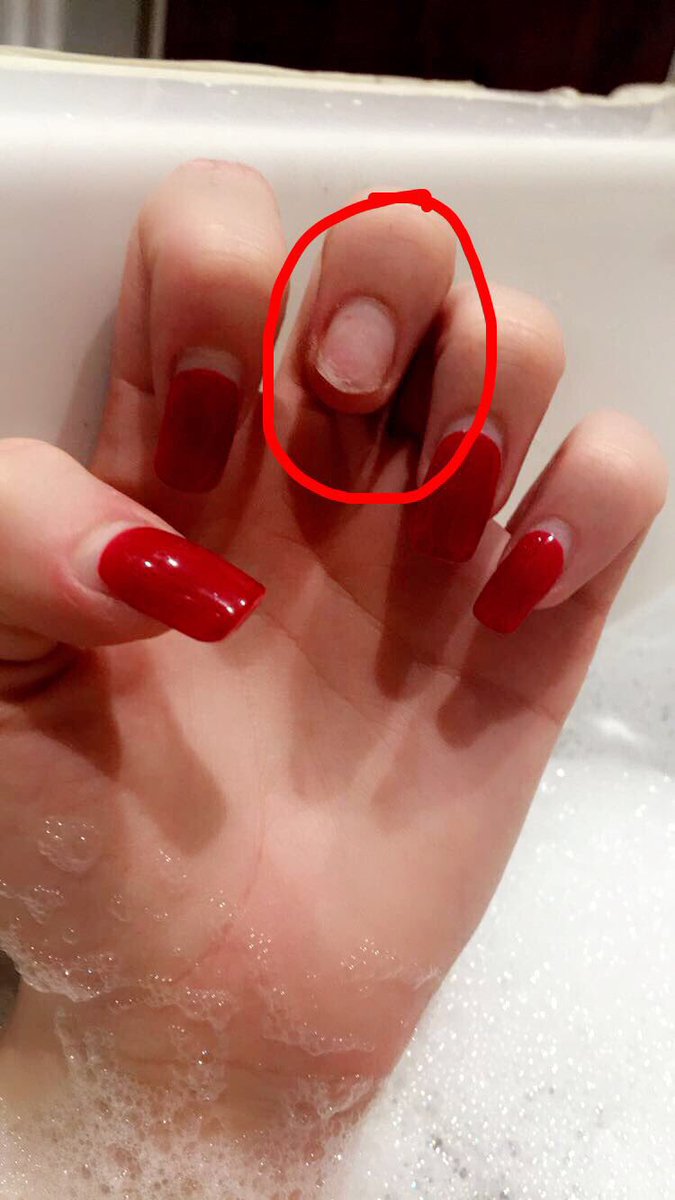 Hannahorme95's tweet image. When you've still got another 2 days to wait until you get your nails infilled and this happens. Absolute worst 😩👊🏻#notcoping