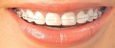 romina_awan's tweet photo. #Orthodontics is the branch of #dentistry that corrects teeth and jaws that are positioned Read More: https://t.co/Jouh8ZEMCW
#dubai #UAE https://t.co/abPG3k11Yd