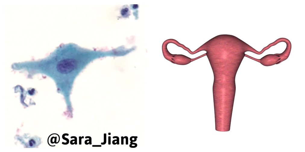 Sara_Jiang's tweet photo. Is this squamous cell pretending to be the organ it came from or am I suffering from #pareidolia? #GynPath #CytoPath https://t.co/zmPHJCguBV