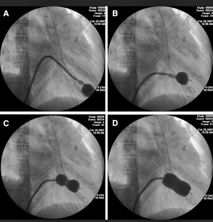 mzkhalil's tweet photo. Stroke risk up to 2% as an immediate complication of mitral balloon valvuloplasty.
:(
#WilkinsEchoScore 
#HeartJC
@pascalmeier74 https://t.co/CCfYdfNSnr