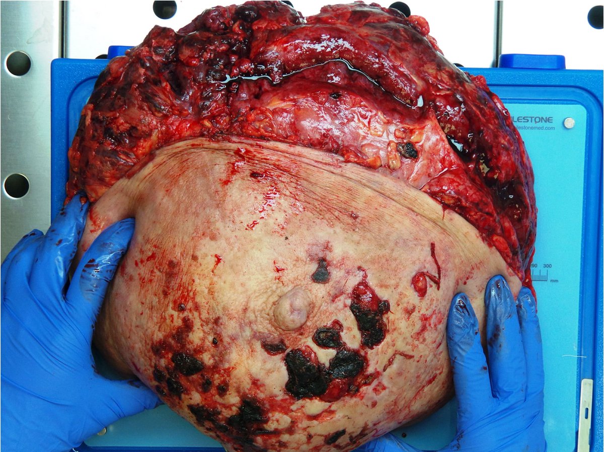 Breast hypertrophy 40 Breast hypertrophy 59