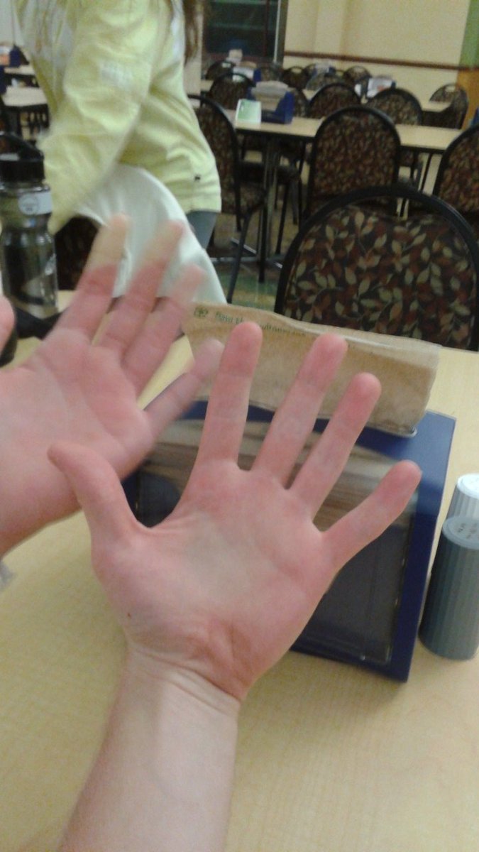 therealwampstar's tweet photo. Hey @IU_ATlyfe  what is up with these hands? Do you know? My hand is on the right just for a reference. Both of her hands are like this. https://t.co/qkxYfciSIK
