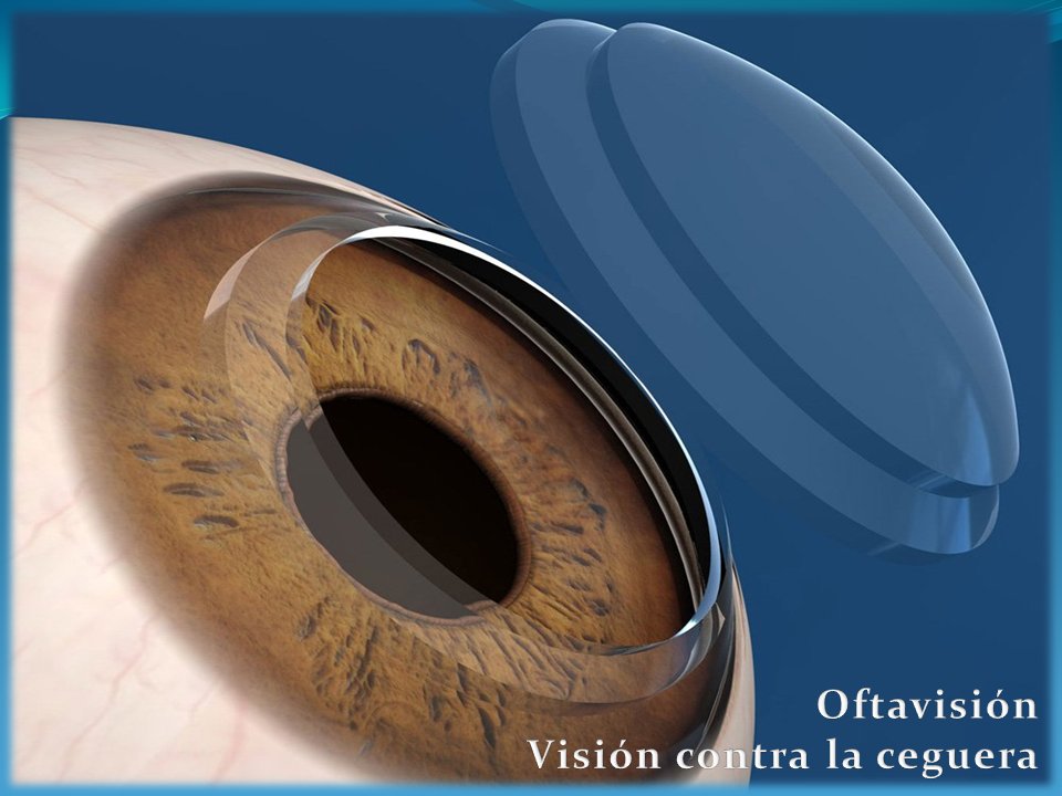 Transplante de córnea: comparación de técnicas

oftavision.com.mx/transplante-de…