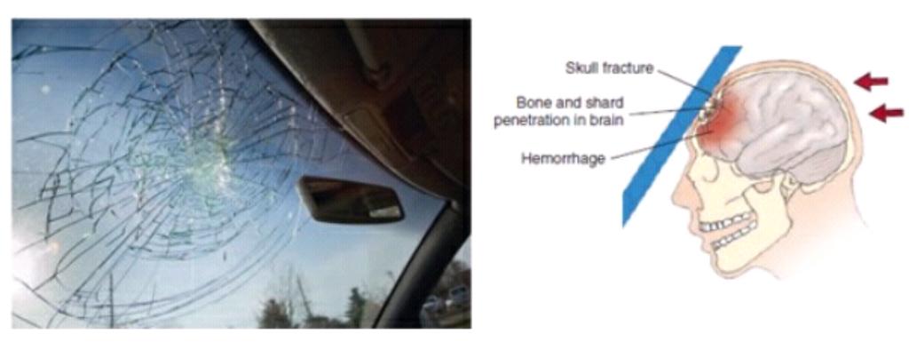 Drsazone No Twitter Mekanisme Kecederaan Kepala Semasa Kemalangan Medtweetmy