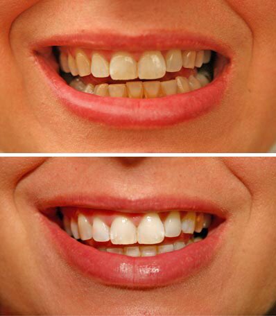 LabWhites's tweet photo. You can achieve results like this within 2 weeks of using our dentist approved Teeth Whitening gel. Shop Now @ https://t.co/Cgxj4URuOf https://t.co/NCtQCQPaXG