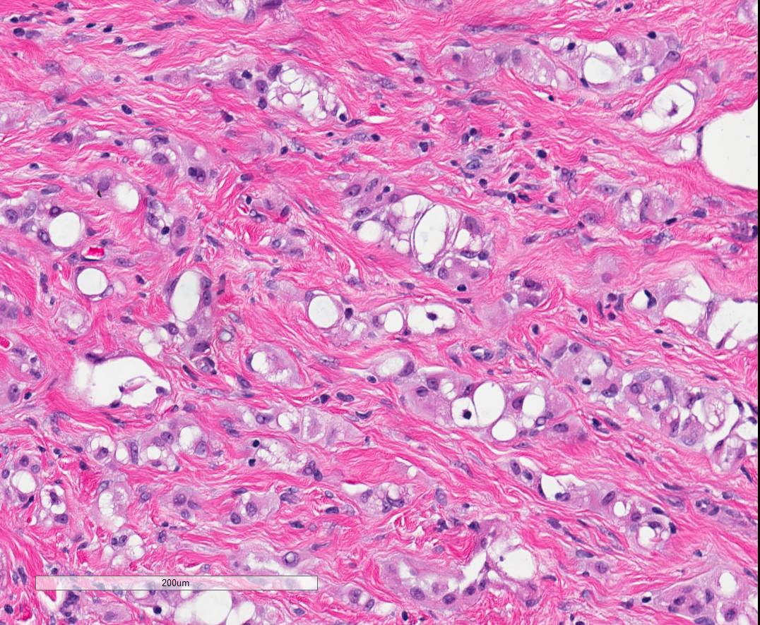 Very busy testicular adenomatoid tumor, mimics an adenocarcinoma. Would be (+) Calretinin, WT-1, CK.  #gupath #pathology