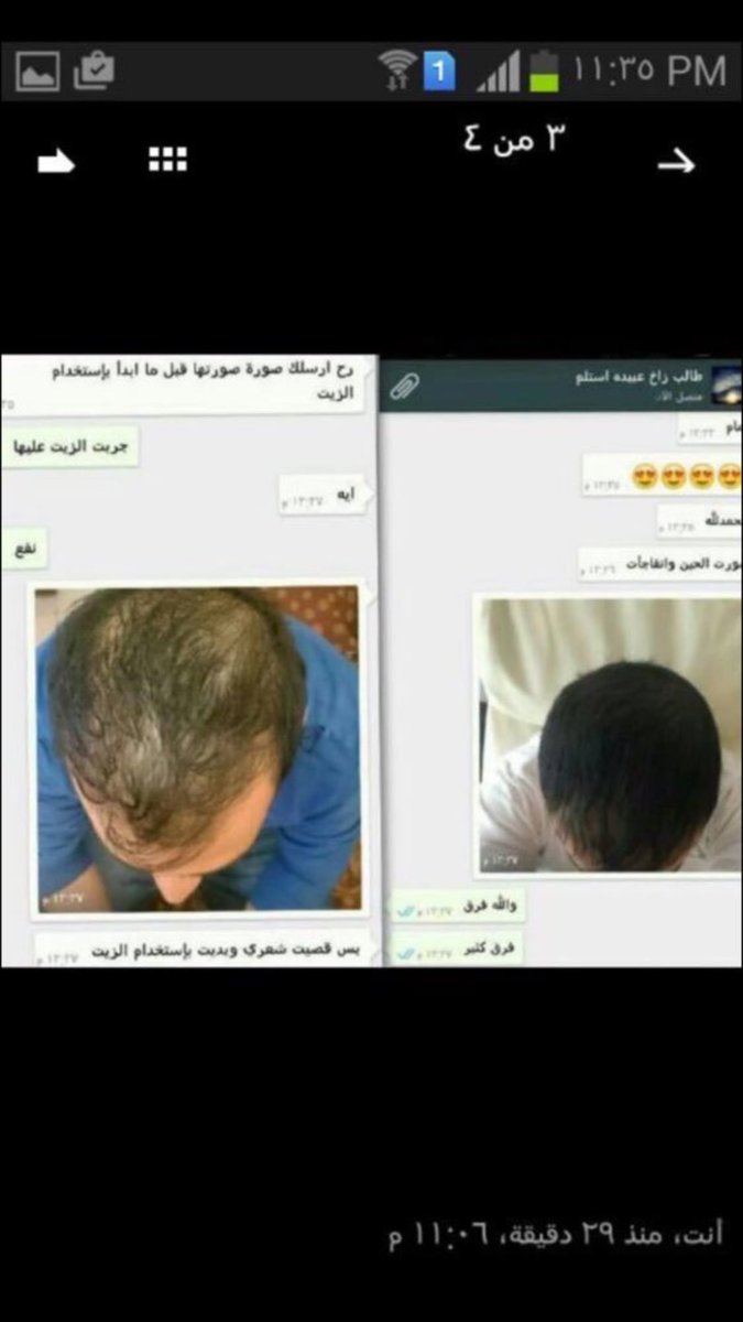 tswq22's tweet photo. زيت الشعرالاصلي خام اسود
علاج
للصلع القشره
تساقط الشعر
يعطي لمعان يعالج مشاكل الدقن والفراغات👌🏻للطلب 0535696658 https://t.co/hIrbexUvoD