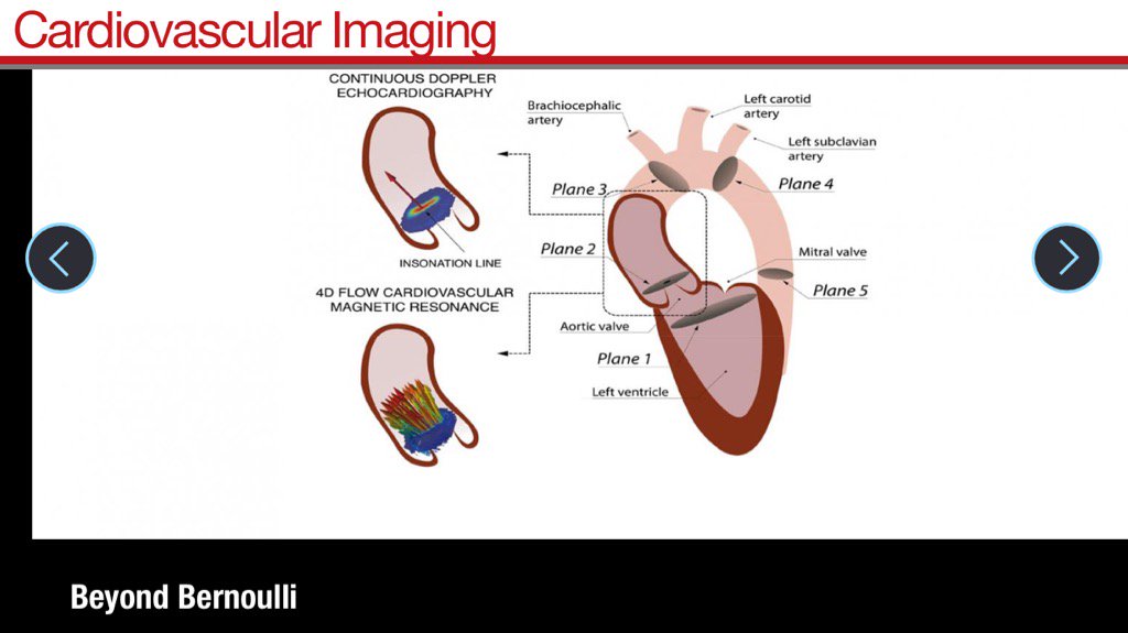 echocardiac's tweet photo. Bernouilli???? #echocardiography #echocardiac #circimaging https://t.co/2njpxOvEmg
