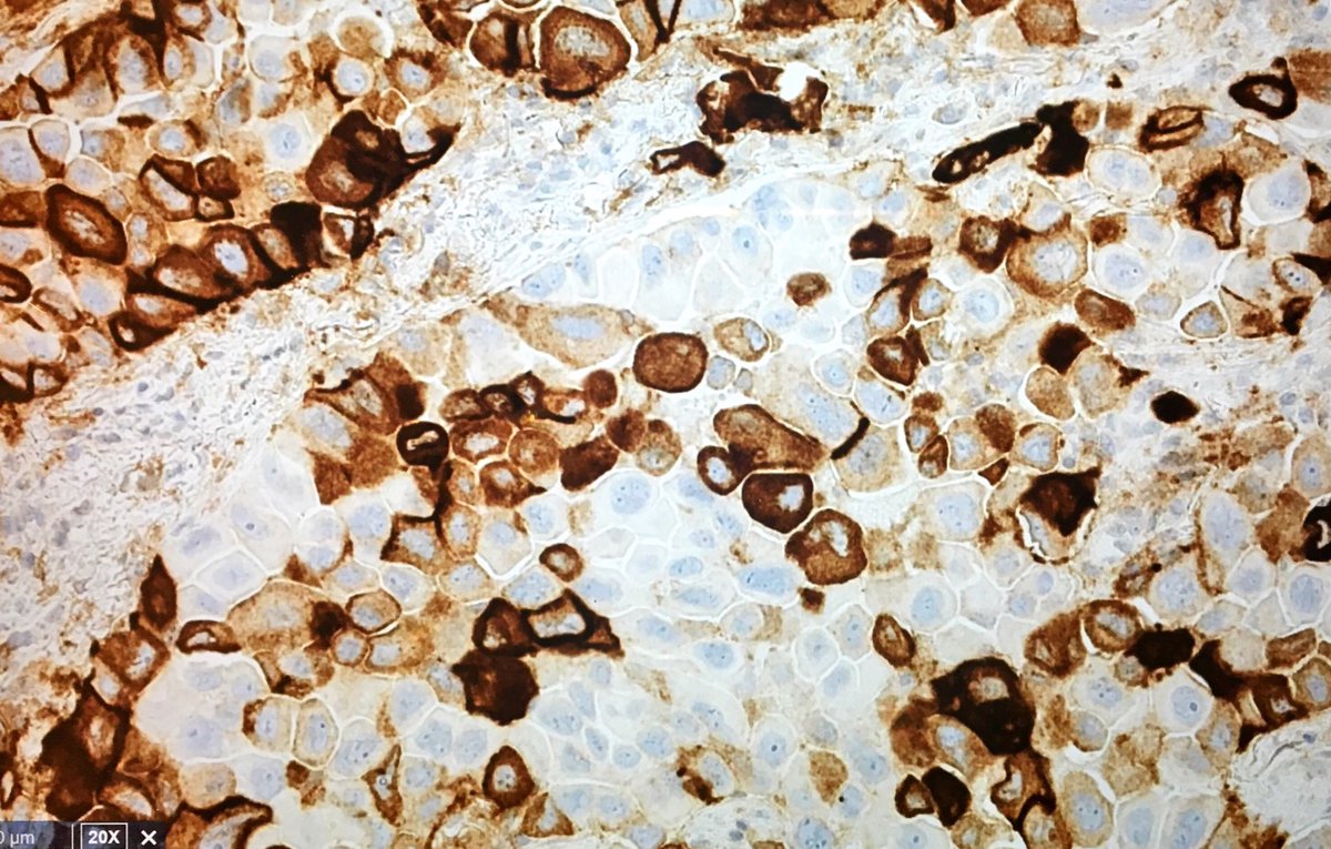 lara_pijuan's tweet photo. Learning to read #PDL1 wt @ventana #SP263 Only membranous staining count, not cytoplasmic & careful not to count macrophages‼️ #pulmpath https://t.co/HWkoKEYS9S