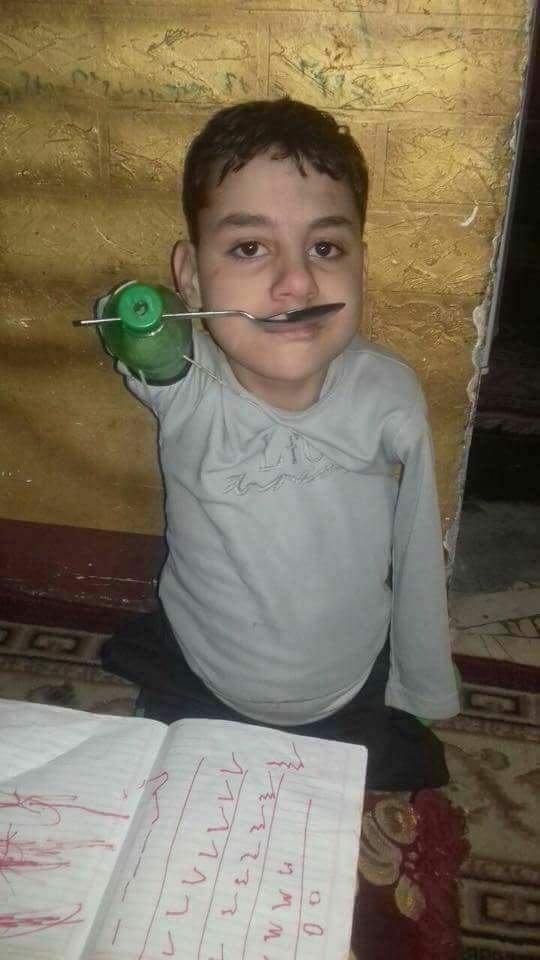 Dorktya's tweet photo. زياد محتاج زراعة أطراف صناعية وليس اجهزة تعويضية 
زياد يحتاج للسفر لامريكا او استراليا

رقم والده 01008785922 للي حابب يتواصل معاهم https://t.co/a4tCUrCJh4