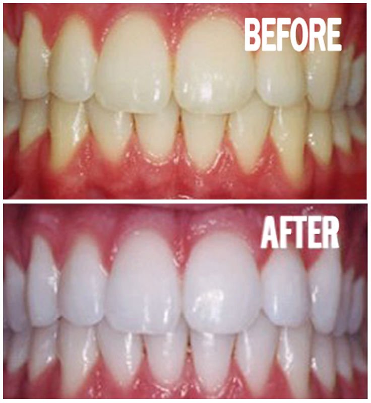 EliteBodyServi1's tweet photo. Visit https://t.co/1C2ucd6nwI to Shop at home Teeth Whitening Kits! $25.00 Bright Smile https://t.co/NdOYrbcyD1