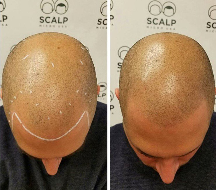 Scalp Micro Usa On Twitter The Soft Look