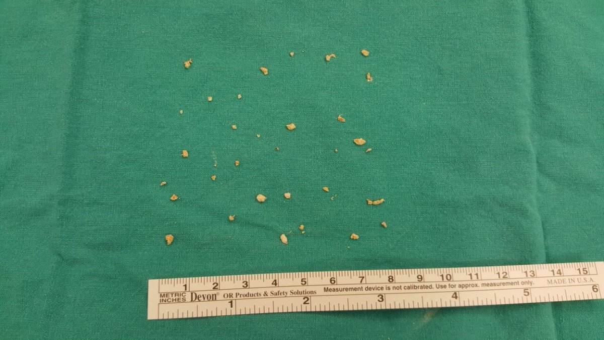 necdet_ozcelik's tweet photo. 3 saat sonuncunda 1,2 cm çapındaki taşı lazer ile kırarak kanaldan çıkardık #sialendoscopy #sialendoskopi #tükürüktaşı #Doctors #ameliyat https://t.co/69S3uZUEWl