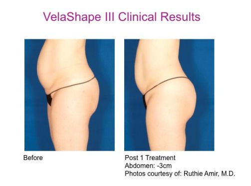 Read about a patient’s experience with VelaShape® and see her incredible results for yourself!  bit.ly/1TM1BWd