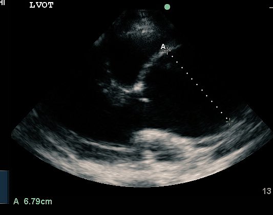 drrobgreig's tweet image. So further to previous cases. 
We went from a non specific presentation to diagnosis within 1min.
Please #learnPoCUS