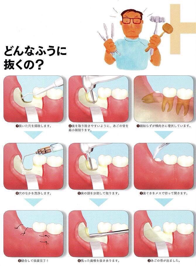 親知らず 横向き