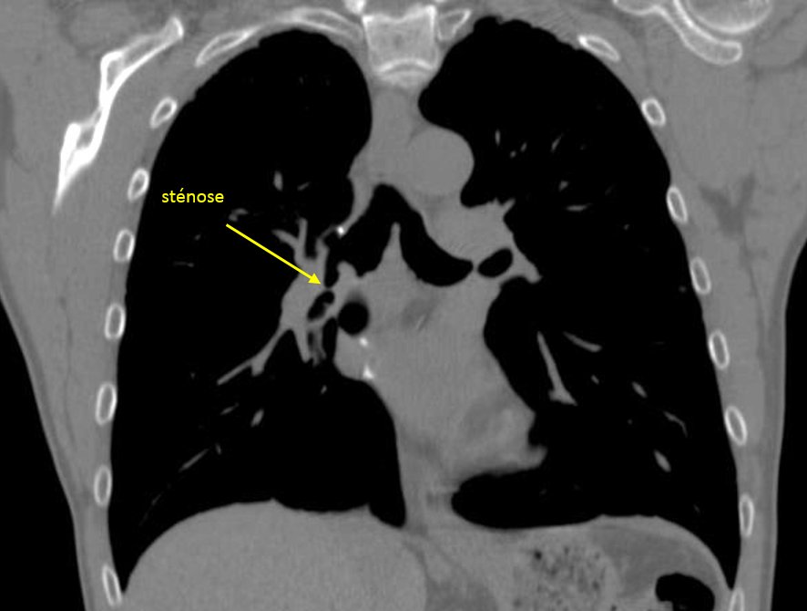 CHUdeToulouse's tweet photo. Nouvelle 1ere mondiale au @CHUdeToulouse : Prothèse trachéobronchique 3D conçue et fabriquée sur mesure #innovation https://t.co/ZCnnWOxbrp https://t.co/VzSnrUC42j
