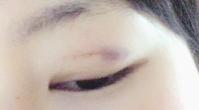 ck2403_5SOS's tweet photo. @5sos_LMCA_sos5 
私、めちゃ幅広希望したで何回もやり直しされて内出血やばめ😂
先生の腕にもよると思う！行くんなら、有名所とかちゃんと口コミ見てから行った方が良いよ👍 https://t.co/yTaQbFzXhF