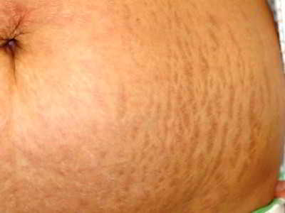 dapurobatcom's tweet photo. #Cara Menghilangkan #Stretch #Mark Atau #Selulit Setelah Melahirkan
https://t.co/FsmpYnAOUb https://t.co/aN4v0u3Ijh