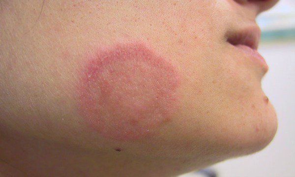 SisquocHC's tweet photo. #Ringworm is a contagious #skin #disease that you need to know about ! https://t.co/jBzzZjRHWS #skincare #healthcare #beauty https://t.co/gL438CabPO