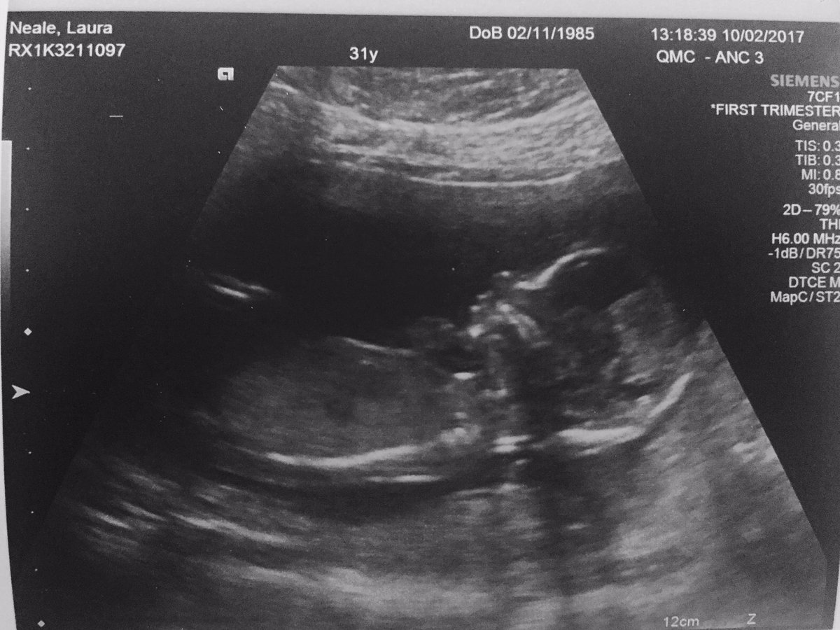 SimCapture45's tweet photo. Soooooooo we are having a baby 😍😍#baby #family #couple #life #blog #follow #viral #newborn #photographer https://t.co/0ZXBzGqsKy