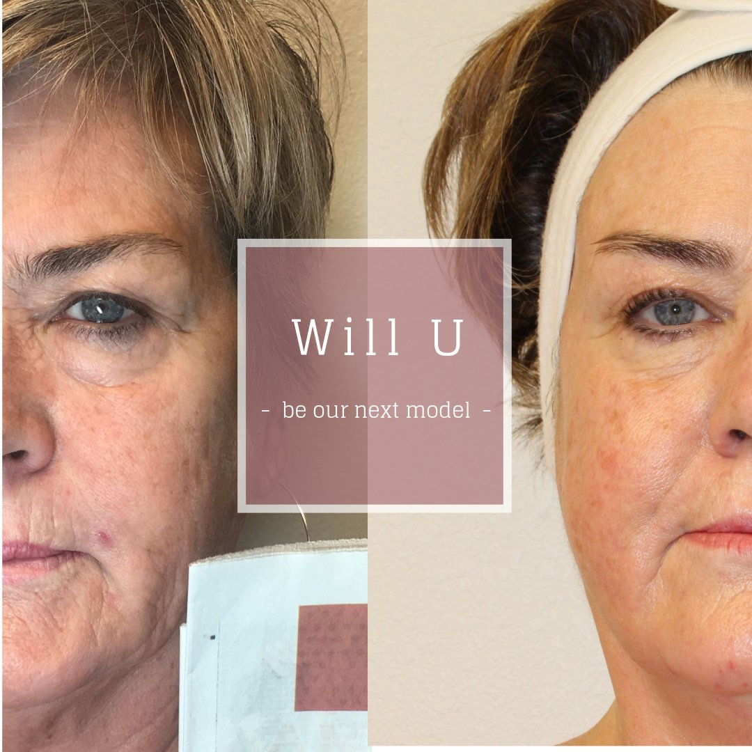 Bashful_Lash's tweet photo. Accepting models 4 skin-revision. Book a consultation&tell how we can help #acne #hyperpigmentation #scars #facebody https://t.co/fmAgjlcO0I