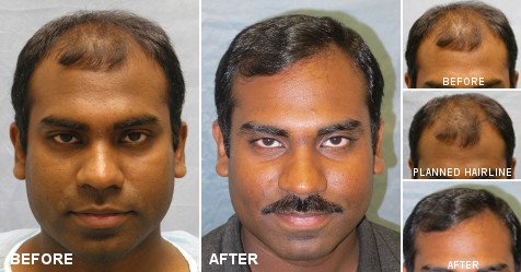 BernsteinHair's tweet photo. See Patient JVI’s #beforeandafter photos + his letter to Dr. Bernstein on the #BernsteinMedical website! https://t.co/eA3VbZ4ZbH #ARTASHair https://t.co/ddYwByFQHK