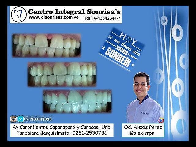 CISonrisas's tweet photo. Presentamos este caso de cierre de diastemas y blanqueamiento, todo en una cita y sin dolor y lo mejor los precios! visitanos! https://t.co/dT3DsehgvS