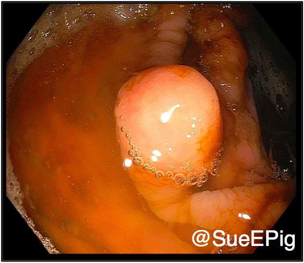 SueEPig's tweet photo. Solitary fibrous tumor presenting as a submucosal colonic polyp. Read more about our case here: https://t.co/useAxEhXyR https://t.co/yea9znTQR9