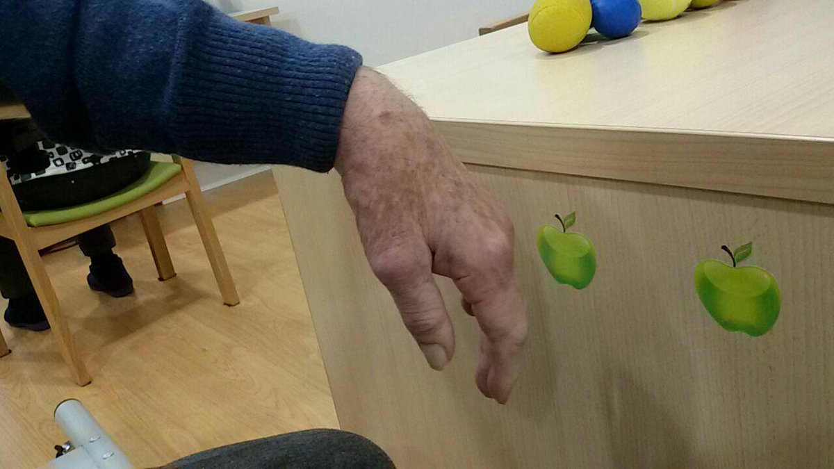 Vitalastur2012's tweet photo. Para un posicionamiento adecuado de la mano neurológica con hipotonía o hipertonía leve-moderada #SaeboStretch #Saebo #ictus #rehabilitacion https://t.co/lDn05IgEll