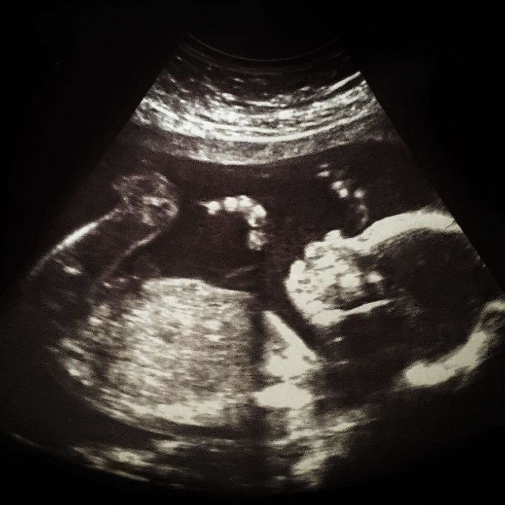 havr69's tweet photo. First Instagram photo of #daughter #ultrasound https://t.co/61u1mQjVkR https://t.co/qkCMswcAPK