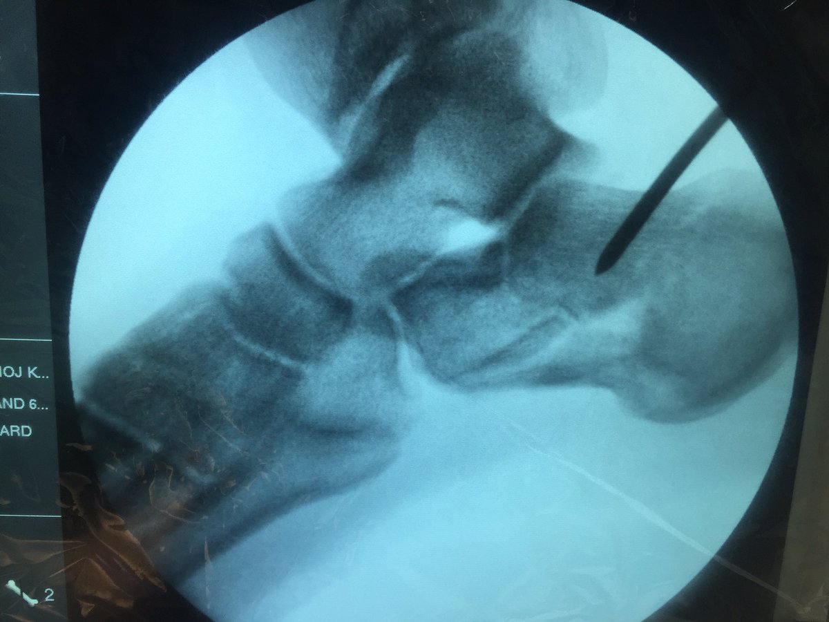 drmanojkrortho1's tweet photo. Rt sided fracture #calcaneum managed with #CRIF with #PTCCS. Reduction achieved by #essex_leprosity method https://t.co/IQnDHIRHTN