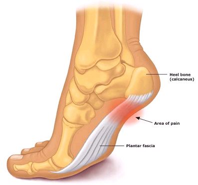 advbackneckcare's tweet photo. Did your know your #chiroproactor can help heal #Plantarfasciitis? #chiropracticadjustment #holistichealth #footpain https://t.co/JNV8FTQNSi