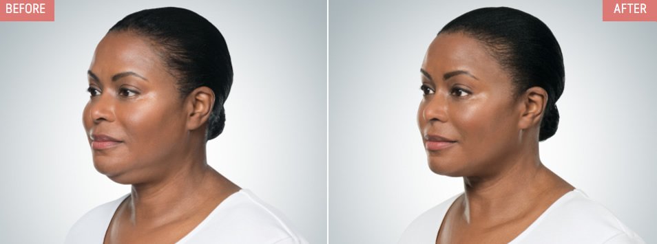 OC_Aesthetics's tweet photo. Now Offering #KYBELLA® - SUBMENTAL FULLNESS "#DOUBLECHIN" TREATMENT https://t.co/xpapuVUjJJ #kybellairvine #iimcs #ocaesthetics #allergan https://t.co/rNvmmp57kf