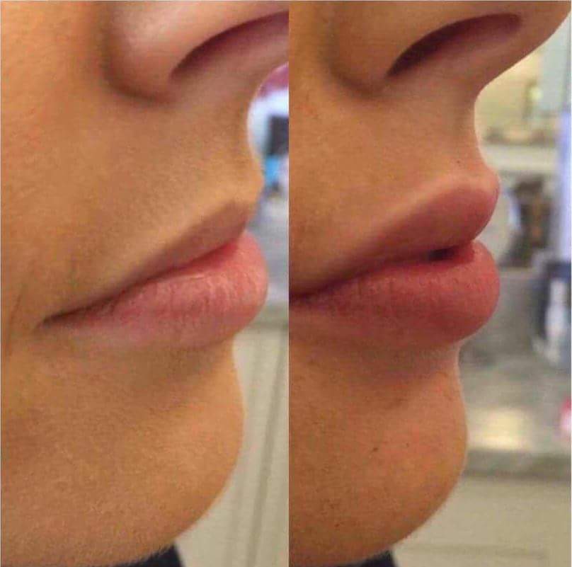 T0talWellbeing's tweet photo. Collagen Lipgloss! Want bigger lips without needles? 
CLINICALLY proven 2 produce 40% more collagen growth especially within ur Cupids bow 👄 https://t.co/TCWizDLW3s