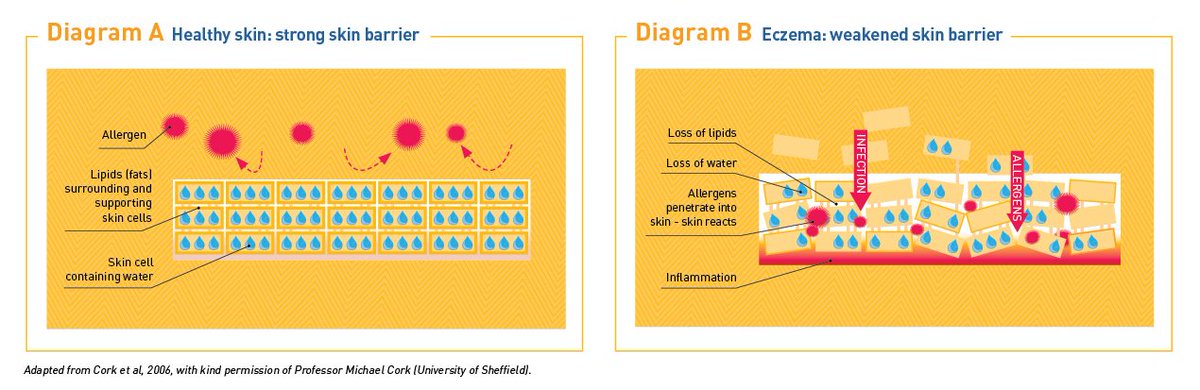 ISFcharity's tweet photo. AD & other types of #eczema are very common & the dry, itchy and damaged skin can be difficult to manage https://t.co/7pxe40Q7RF https://t.co/wguk2NZVFS