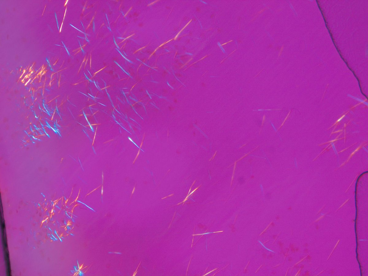 Uric acid crystals hi-res stock photography and images - Alamy, image size:1200x900